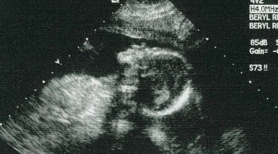 Ultrasound